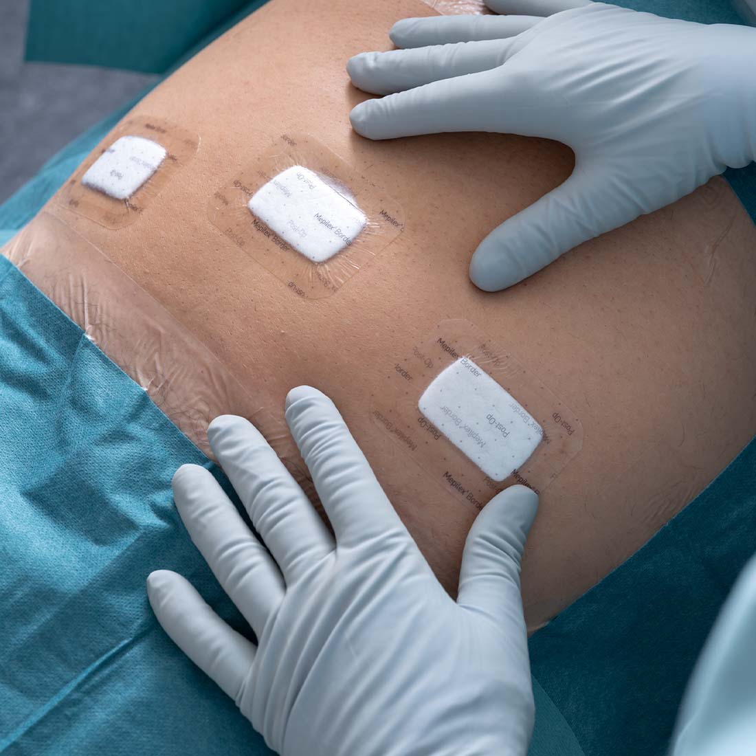 Curativo Pós-operatório Mepilex Border Post-Op - Imagem 7